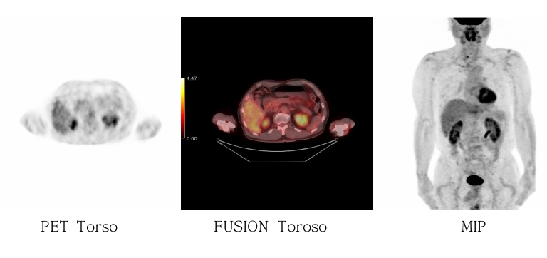 PET CT Torso 이미지