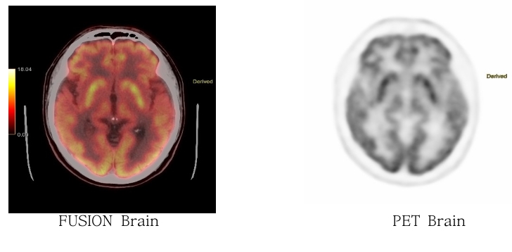 PET CT Brain 이미지