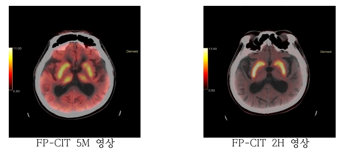 PET CT FP-CIT 이미지